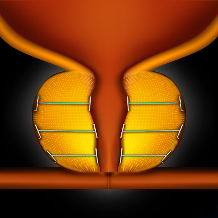 The UroLift System treatment
