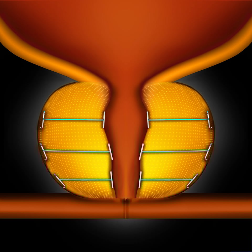 The UroLift System treatment