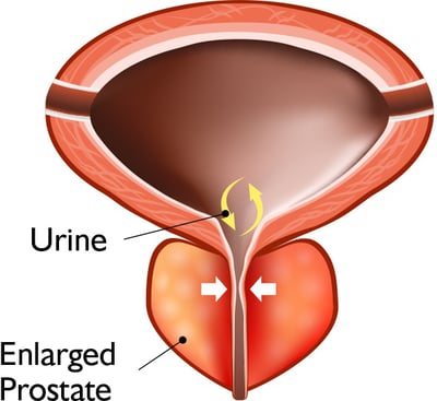 Diagram of a prostate with BPH