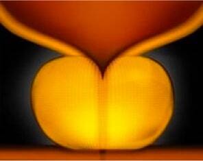 An enlarged prostate